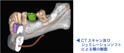 CTスキャン及びシュミレーションソフトによる顎の断面